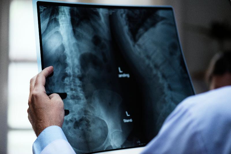 Radiografía escoliosis Radiografía escoliosis